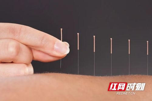 湖南省直中医医院针灸疼痛科 传承经典,开拓创新,针灸 升级