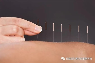石家庄炎黄针灸推拿学校:针灸实战寒假班1月4日温暖起航!