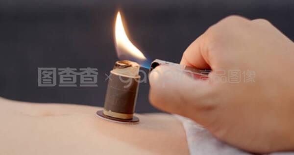 中医针灸疗法