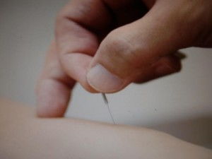 针灸治疗颈椎病的原理与实践