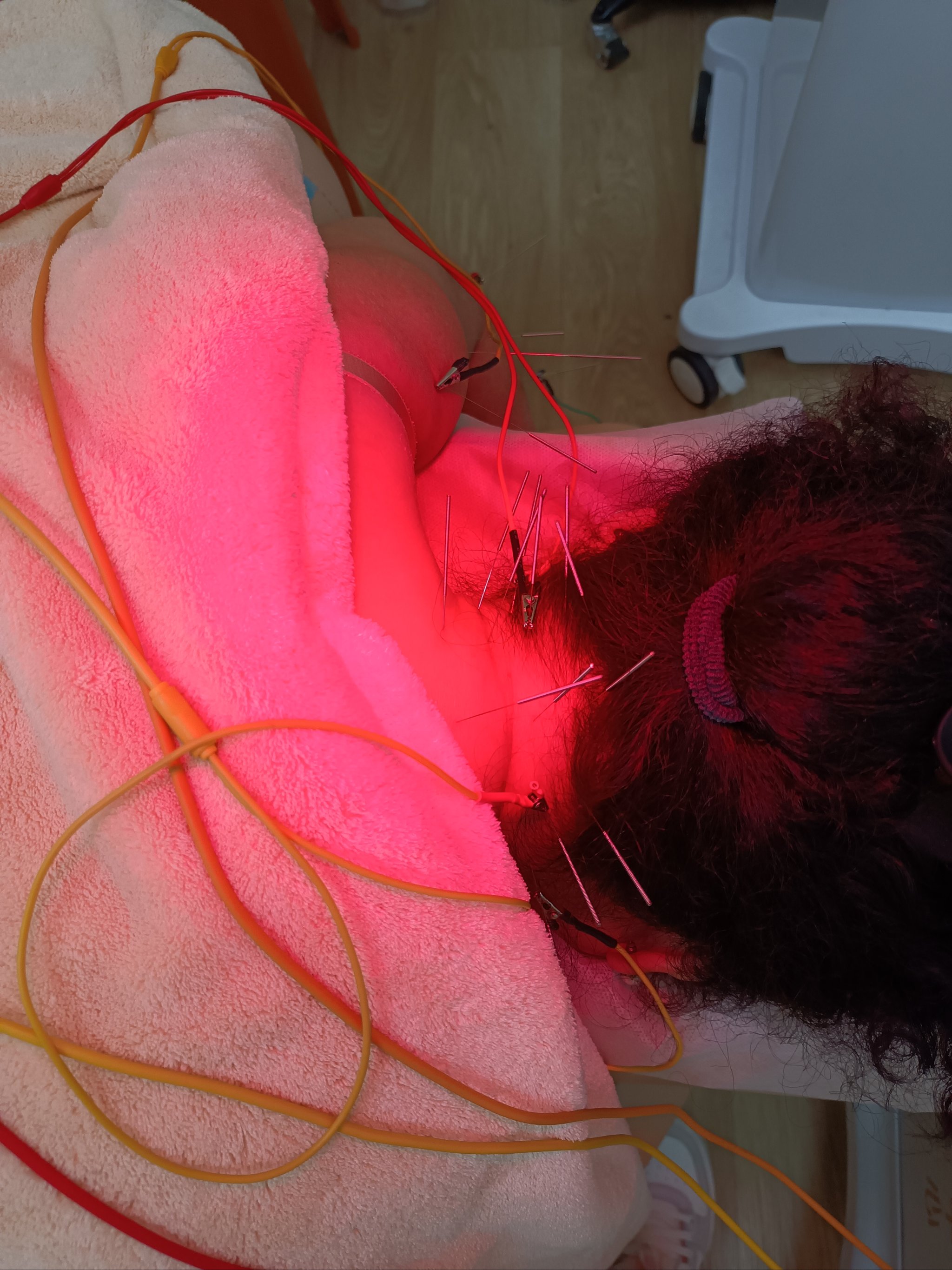 针刺调枢，通络止痛 针灸治疗左上肢胀痛的神经根型颈椎病探析