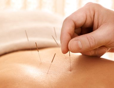 探秘中医针灸 传承千年的智慧，你需要了解的优势、局限与注意事项